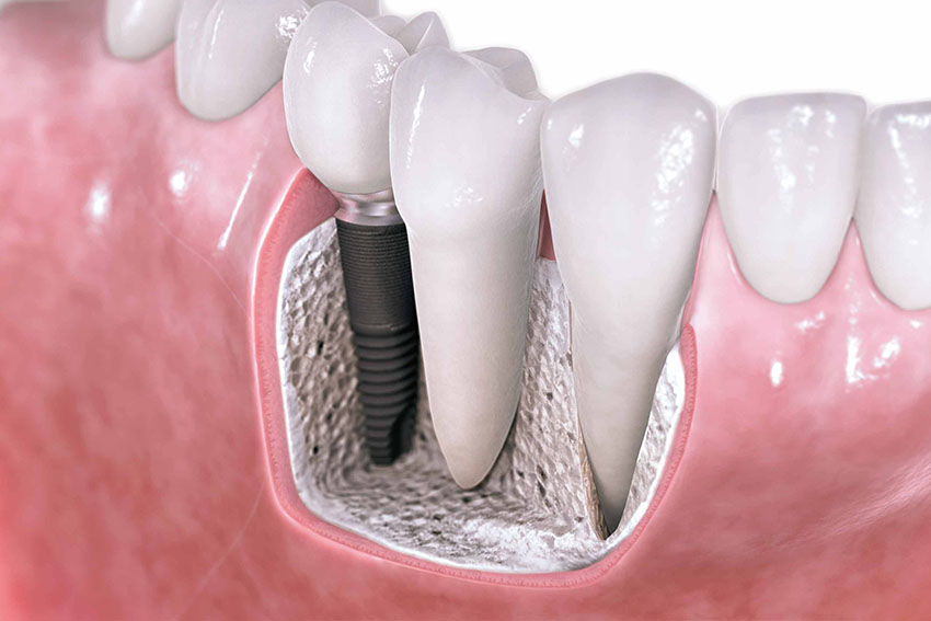 Starlight-dental-clinic-bone-graft-sinus-lift