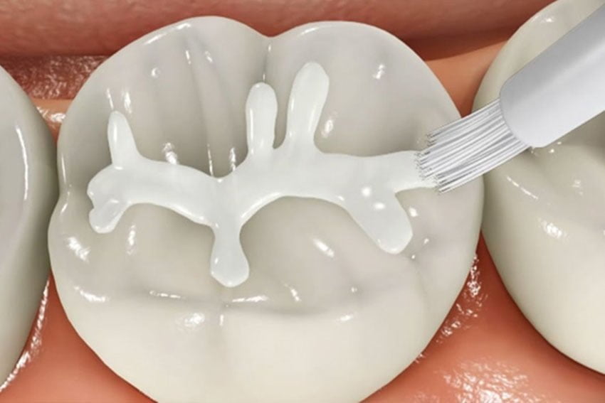 Starlight-dental-clinic-dental-sealants