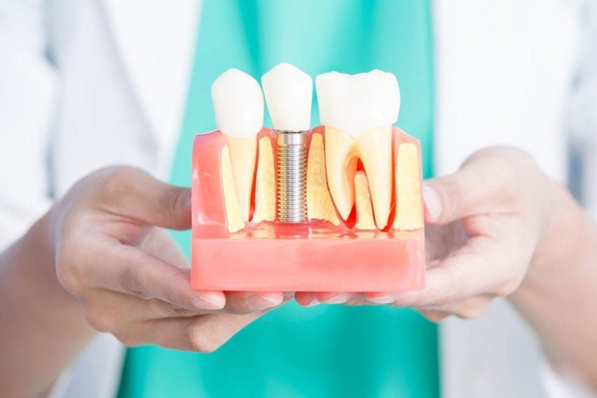 Starlight-dental-clinic-dental-implant