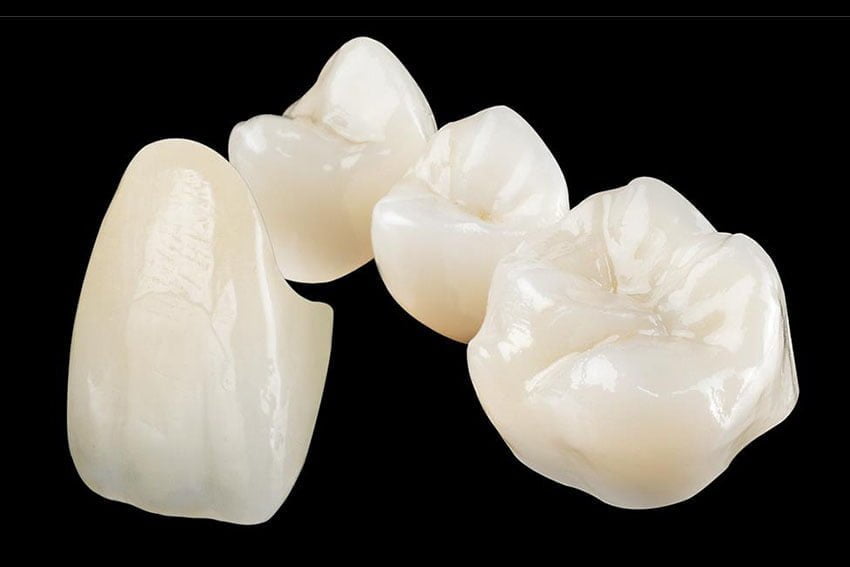 Starlight-dental-clinic-full-ceramic-crown-onlay