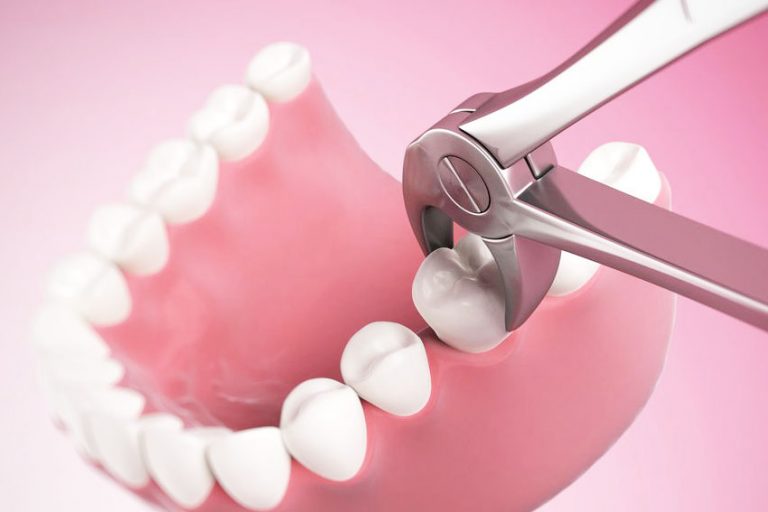 starlight-dental-clinic-tooth-removal-extraction