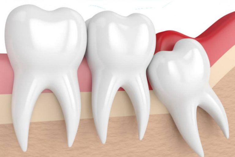 Starlight-dental-clinic-wisdom-tooth-extraction
