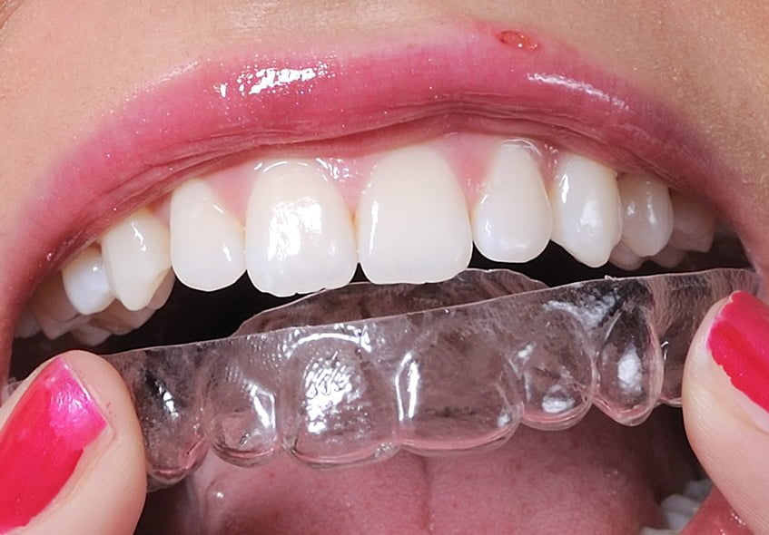 starlight-dental-clinic-nieng-rang-trong-suot